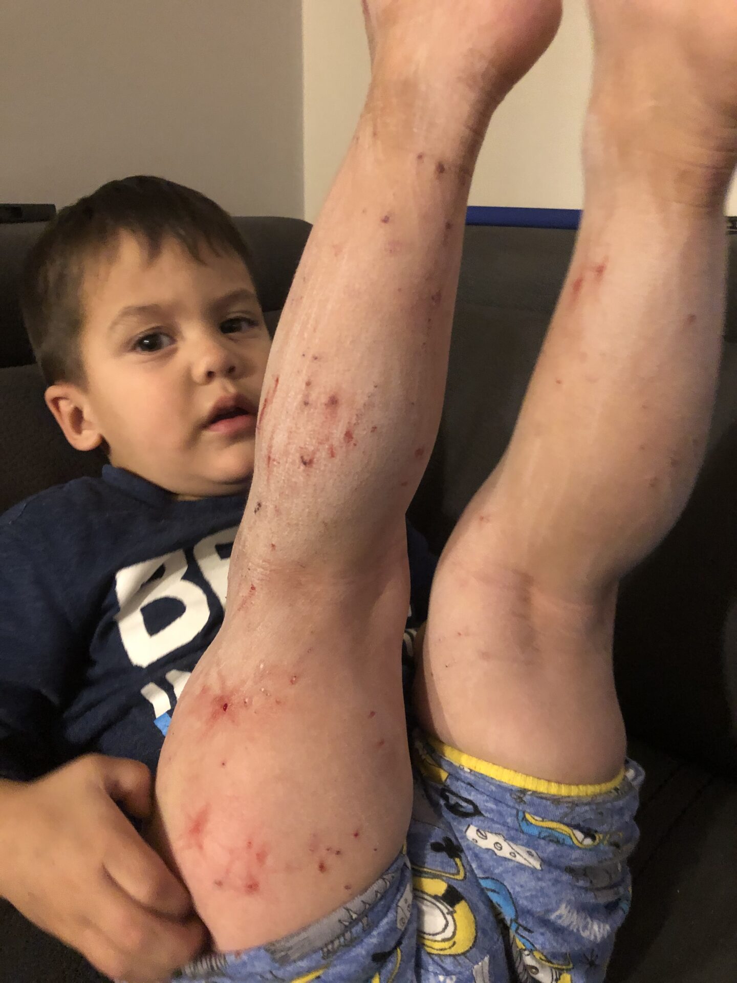 child with pruritus and scratching injuries